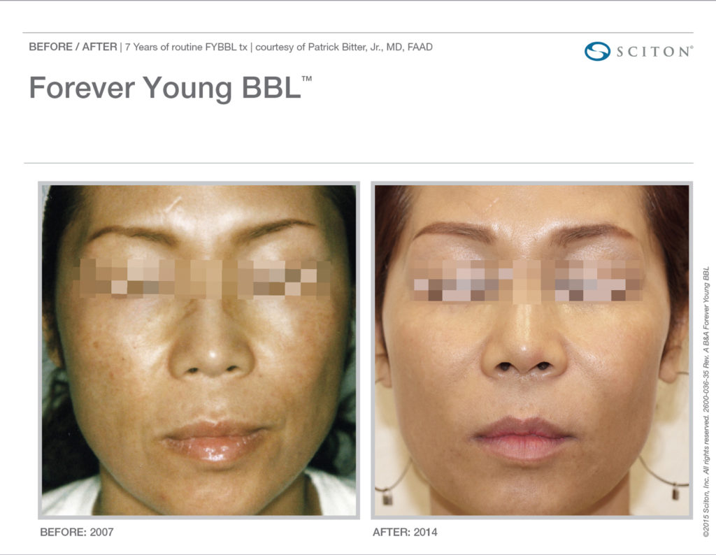 ForeverYoung BBL before and after photo