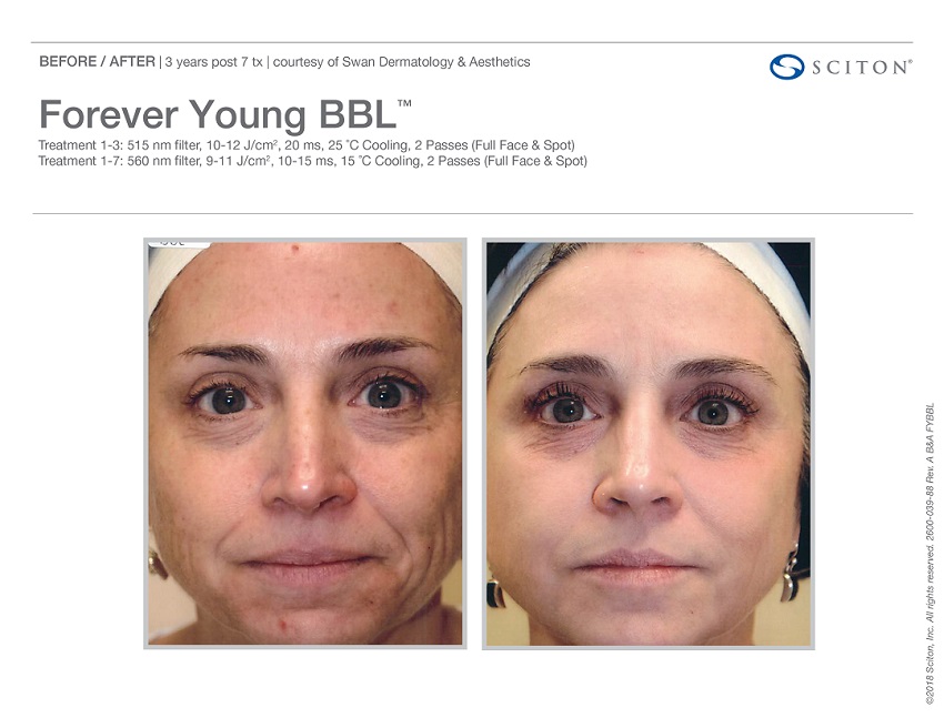 ForeverYoung BBL Before and After photos