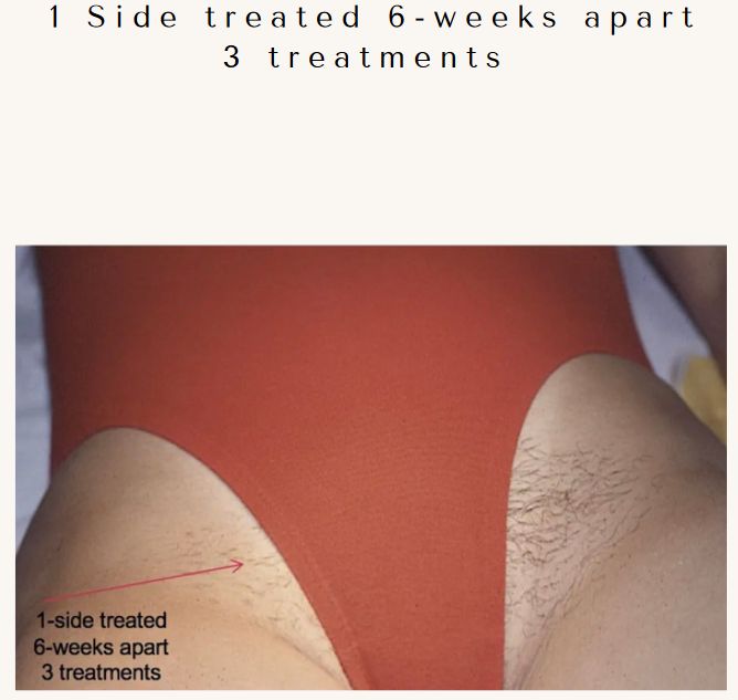 Laser hair removal by Cervello Laser: Bikini area Before & After