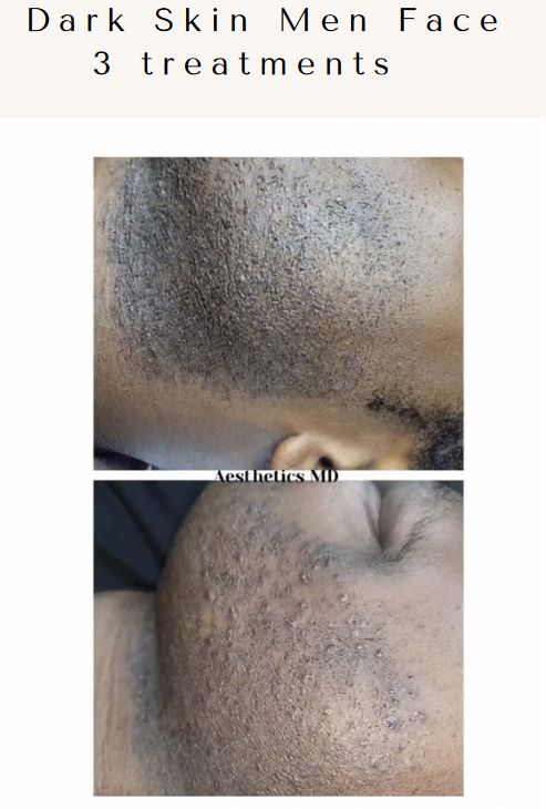 Laser hair removal by Cervello Laser: Dark Skin Man's Face Before & After