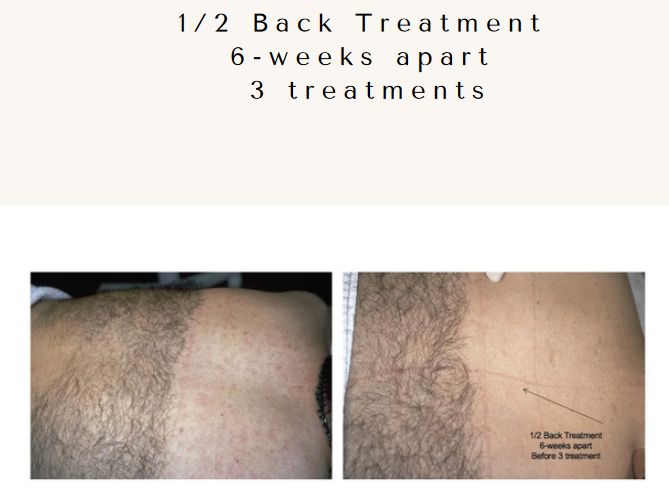 Laser hair removal by Cervello Laser: Men's Back Before & After