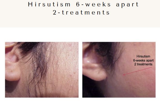 Laser hair removal by Cervello Laser: sideburns Before & After